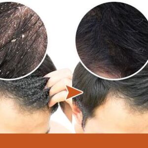 Anti-Dandruff Treatment Essence Serum