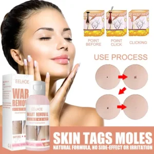 Herbal Wart Skin Removal Ointment