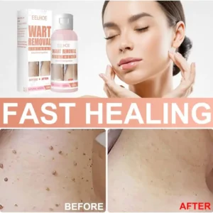 Herbal Wart Skin Removal Ointment