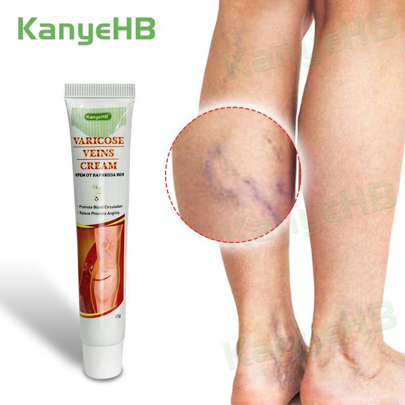 Varicose Veins Miracle Cream