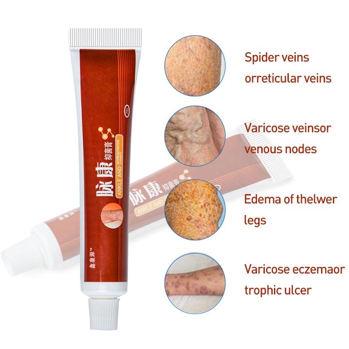 Varicose Veins Miracle Cream