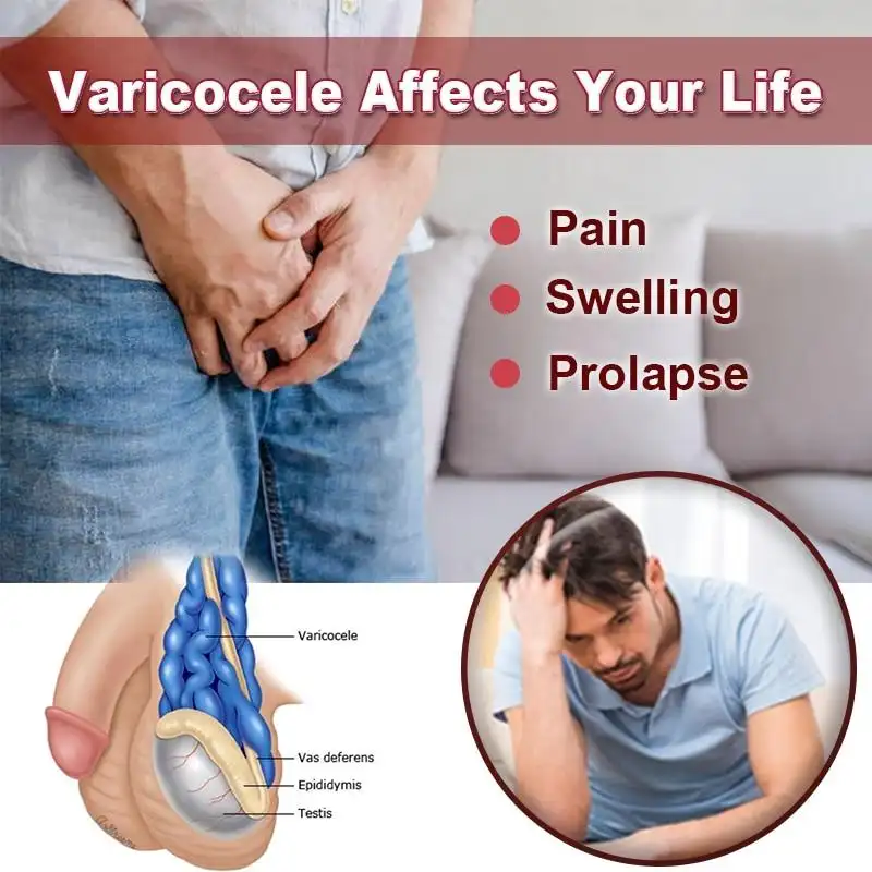 Varicose Veins Miracle Cream