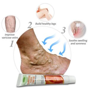 Varicose Veins Miracle Cream