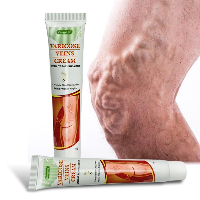 Varicose Veins Miracle Cream