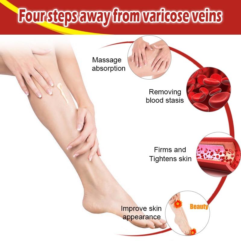 Varicose Veins Miracle Cream