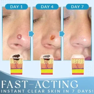 Derma'Pro Mole & Wart Remove Treatment Set