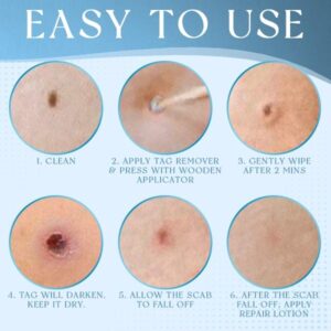 Alternative view of Derma'Pro Mole & Wart Remove Treatment Set