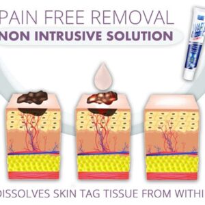 Instant Skin Tag Removal Mousse