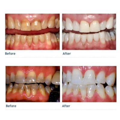 Nano Teeth Whitening Kit