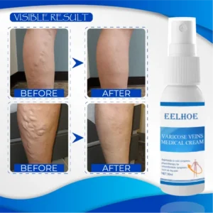 Organic AntiVaricose MiracleSpray