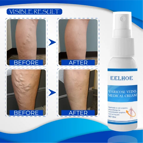Organic AntiVaricose MiracleSpray