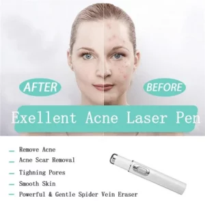 Blue Light Therapy Varicose Veins Pen