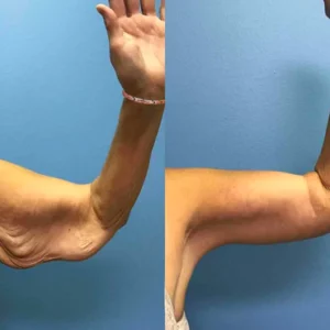 Magnetic Lymph Detox Bracelet
