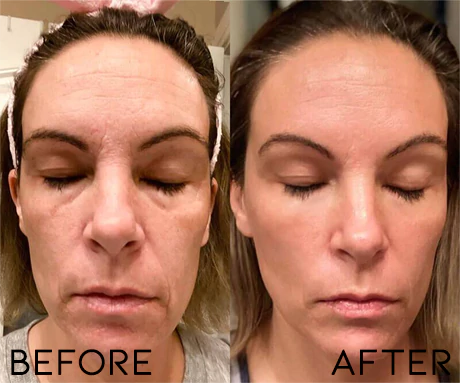 EMS Facial Lift Rejuvenation Kit