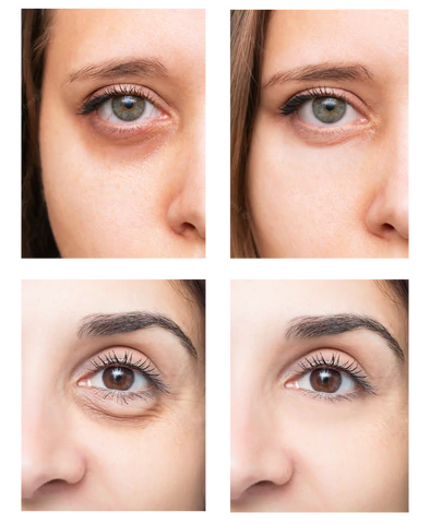 Ionic Eye Contouring System