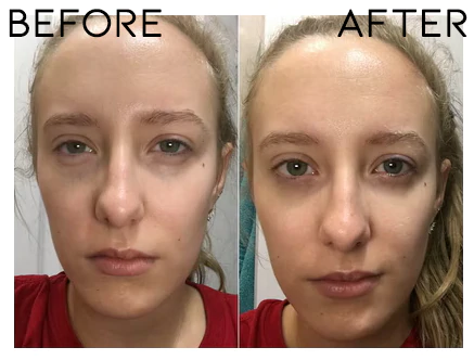 Ionic Eye Contouring System