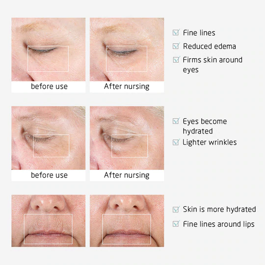 Ionic Eye Contouring System