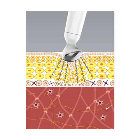 Ionic Eye Contouring System