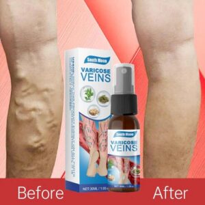 Varicose Veins Miracle Spray