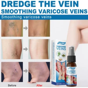 Varicose Veins Miracle Spray