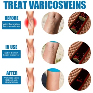 Varicose Veins Miracle Spray