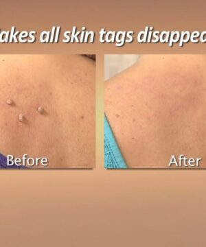 Copper Tag Out Skin Tag Remover
