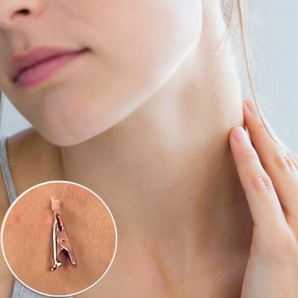 Copper Tag Out Skin Tag Remover