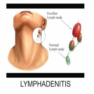 Nutrispot Neck Lymphatic Detox Patch (Set of 10)