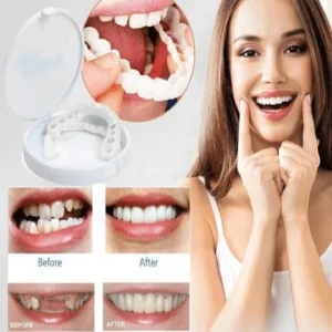 Perfect Smile Snap On Braces
