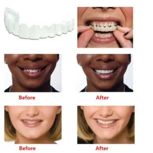 Perfect Smile Snap On Braces
