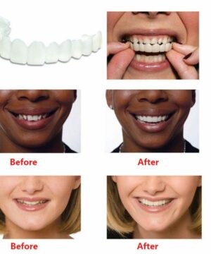 Perfect Smile Snap On Braces