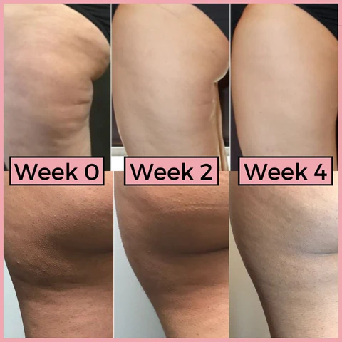 Anti Cellulite Massage Roller