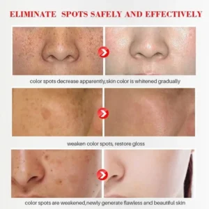 Freckle Whitening Cream