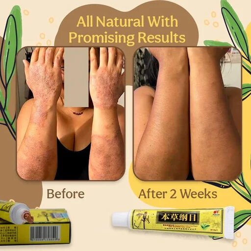 Organic Eczema Herbal Healing Cream