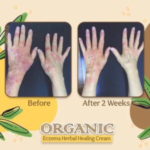 Organic Eczema Herbal Healing Cream