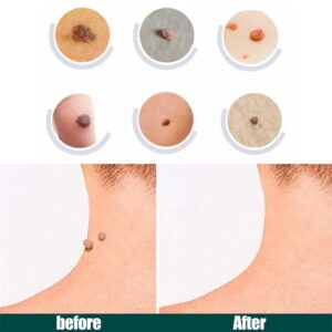 Skin Tag Remover Patch 120 Pcs
