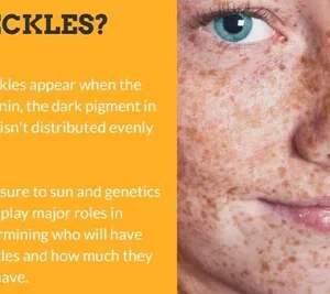 Spot-Off™ Freckle Whitening Cream