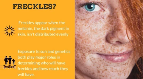 Spot-Off™ Freckle Whitening Cream