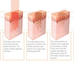 Spot-Off™ Freckle Whitening Cream