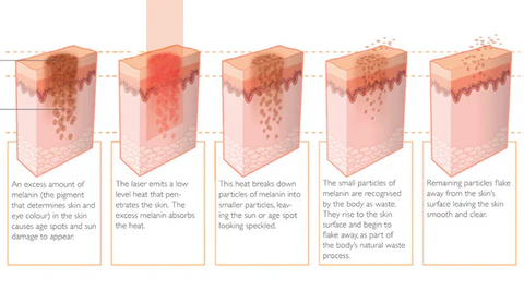 Spot-Off™ Freckle Whitening Cream