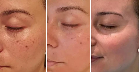 Spot-Off™ Freckle Whitening Cream