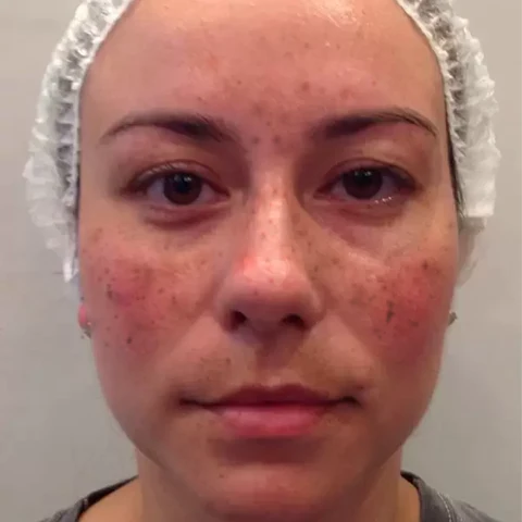 Spot-Off™ Freckle Whitening Cream