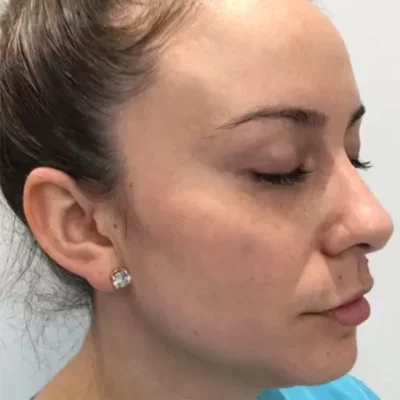 Spot-Off™ Freckle Whitening Cream