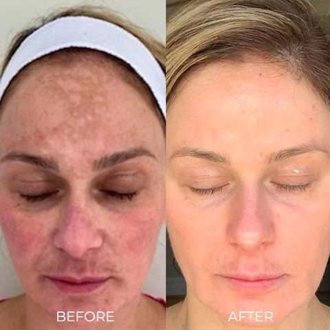 Spot-Off™ Freckle Whitening Cream