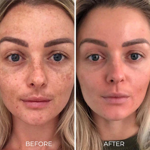 Spot-Off™ Freckle Whitening Cream