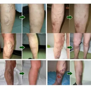 Varicose Veins Herbal Healing Patch