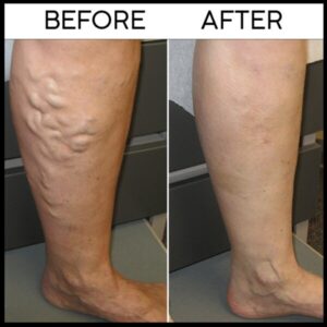Varicose Veins Herbal Healing Patch
