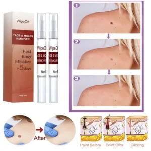 2Pcs Tags & Moles Remover