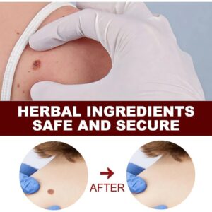 2Pcs Tags & Moles Remover