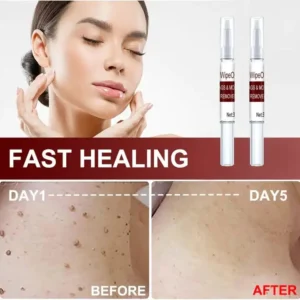 2Pcs Tags & Moles Remover